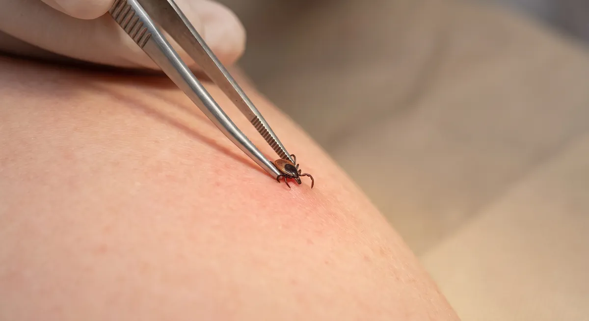 Capusa prinsa de piele si o penseta fina pentru indepartare corecta, consultatie la Adiant Medical Mioveni
